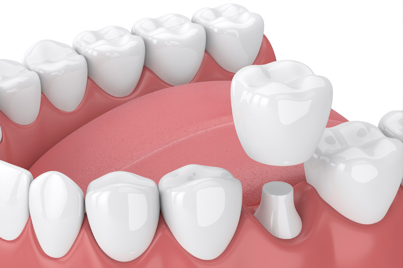 Dental Crowns in Rancho Park, Century City - Los Angeles