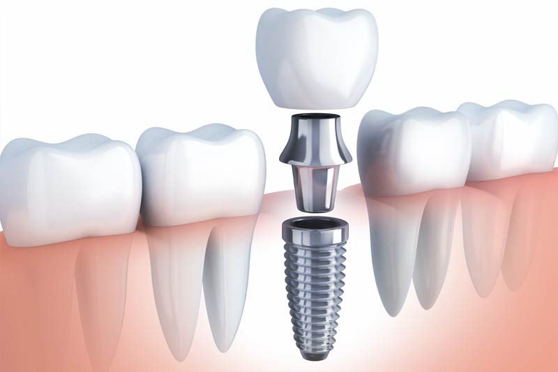 Implants Dentist in Rancho Park, Century City - Los Angeles