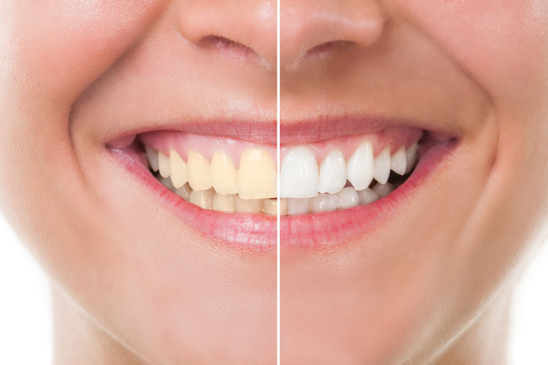 Teeth Whitening in Rancho Park, Century City - Los Angeles