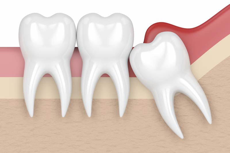 Wisdom Tooth Removal in Rancho Park, Century City - Los Angeles